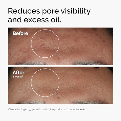 The Ordinary Niacinamide Serum